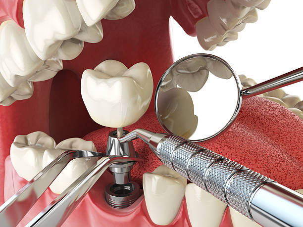 Best Emergency Treatment for Dental Infections or Abscesses in Rolling Hills, CA